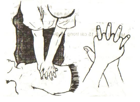 Hô hấp nhân tạo (2)